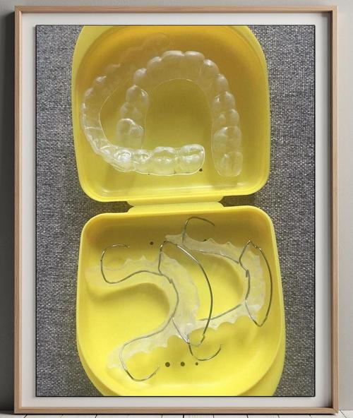 小孩正畸保持器有哪几种类型?如何正确选择和使用?-图1 小孩正畸保持器有哪几种类型?如何正确选择和使用?-图1