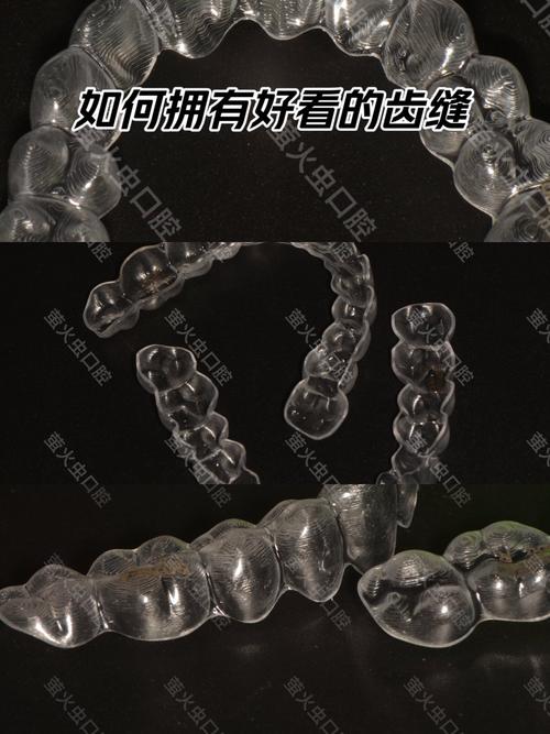 小孩正畸保持器有哪几种类型?如何正确选择和使用?-图3 小孩正畸保持器有哪几种类型?如何正确选择和使用?-图3