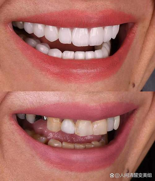 磨牙烤瓷牙能否进行正畸治疗?-图3 磨牙烤瓷牙能否进行正畸治疗?-图3