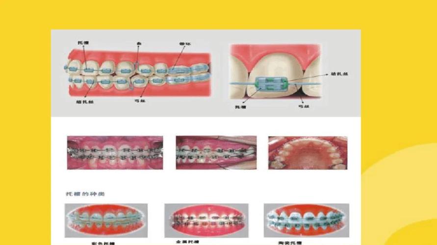 口腔科正畸材料有哪些？各类材料的具体用途是什么？-图2