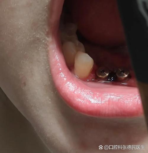 种牙后肿胀一般持续多少天?-图3 种牙后肿胀一般持续多少天?-图3