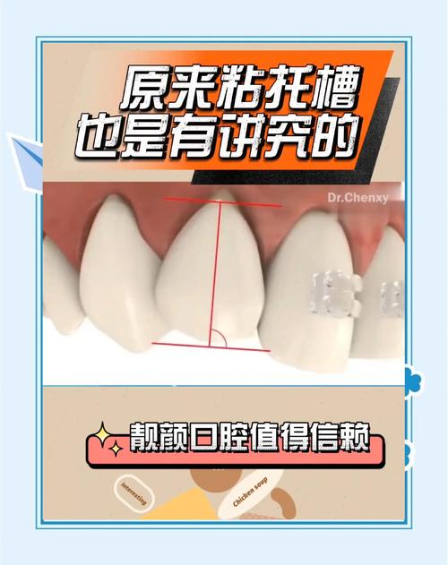 正畸粘接全口托槽的标准步骤及操作要点有哪些？-图2