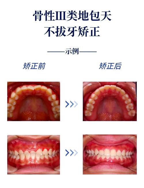 牙性反颌正畸矫正牙齿的过程是怎样的?-图2 牙性反颌正畸矫正牙齿的过程是怎样的?-图2