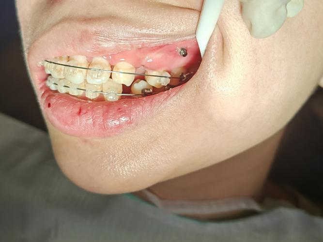 正畸牙齿后为何不能吃东西？饮食限制何时能解除？-图3