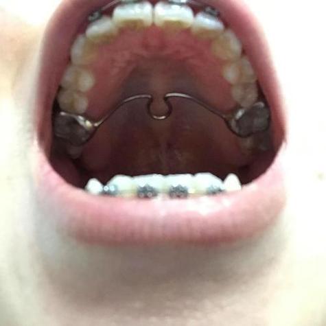 牙齿正畸导板太难受，到底该怎么办？-图2