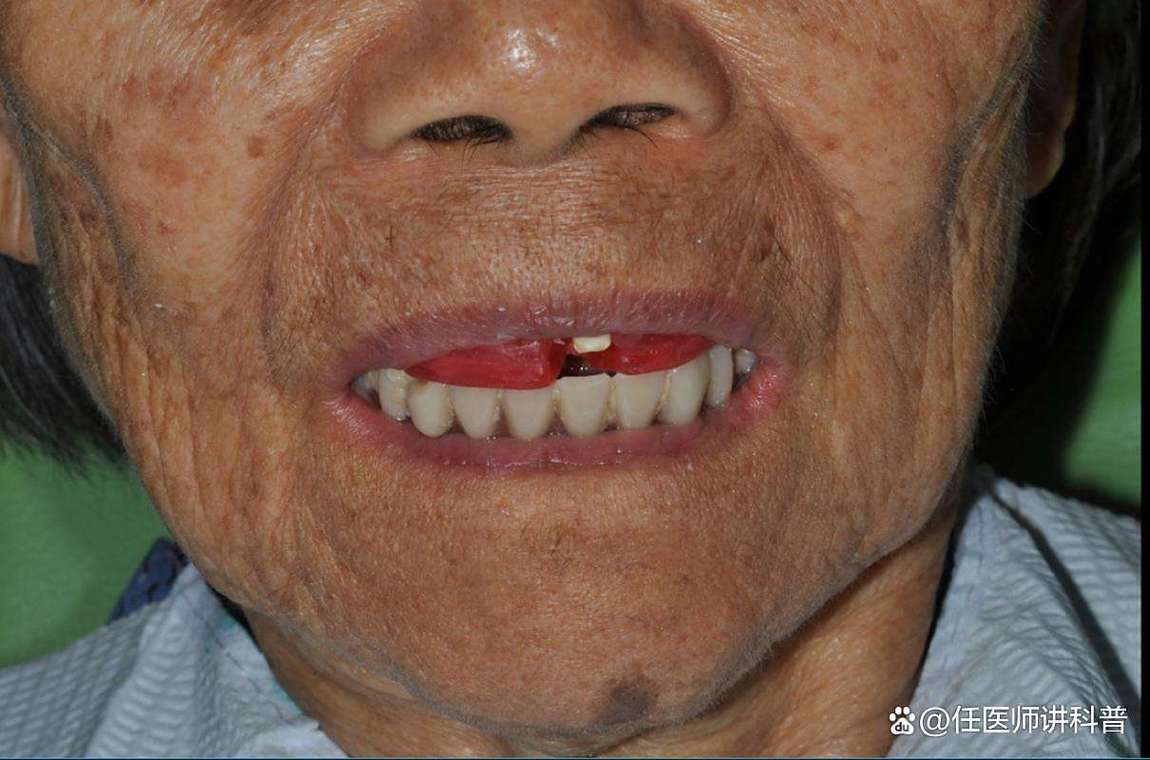 日本为何叫停种植牙？背后原因引热议-图2