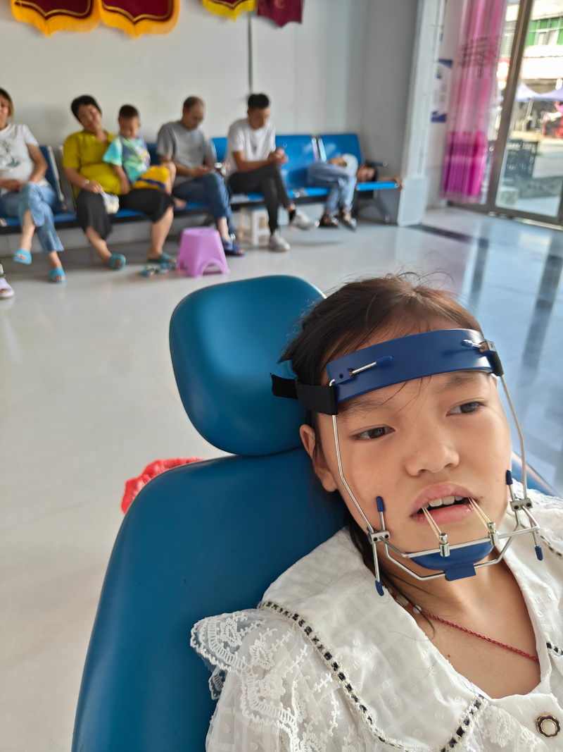 儿童反颌有哪些好的治疗方法？-图2