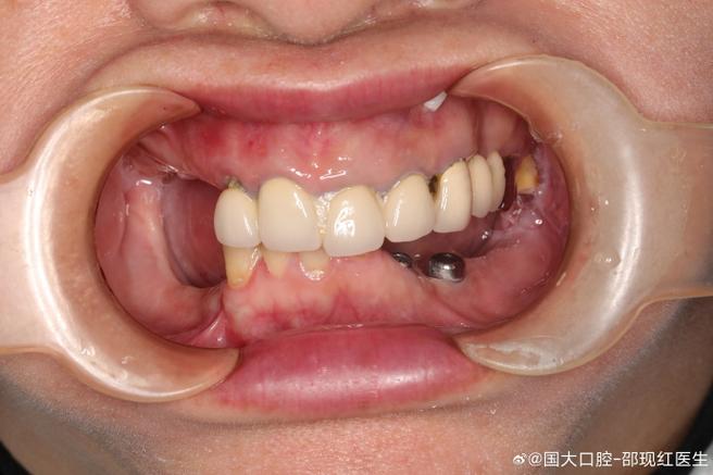 游离缺失可以做种植牙修复吗?这样可行吗?-图2 游离缺失可以做种植牙修复吗?这样可行吗?-图2