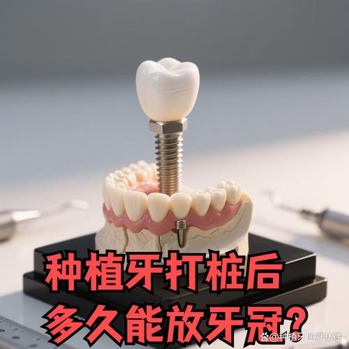 种牙后牙冠制作要多久？一般需要多长时间？-图1