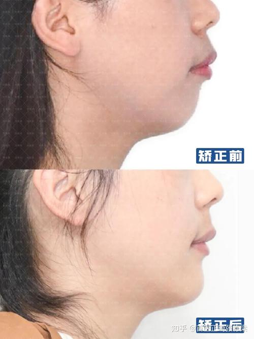 正畸什么脸型改变大？龅牙还是地包天效果显著？-图1