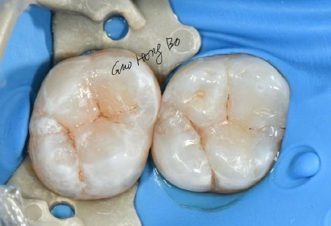 正畸后最后一颗牙窝沟龋，为何发生对口腔有何影响又该如何有效解决？-图2