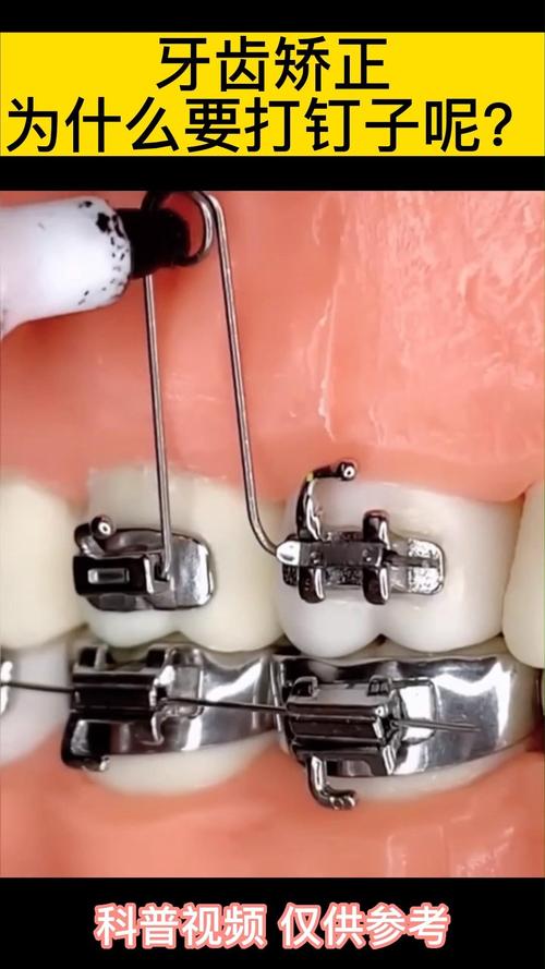 正畸打钢钉什么时候打-图2