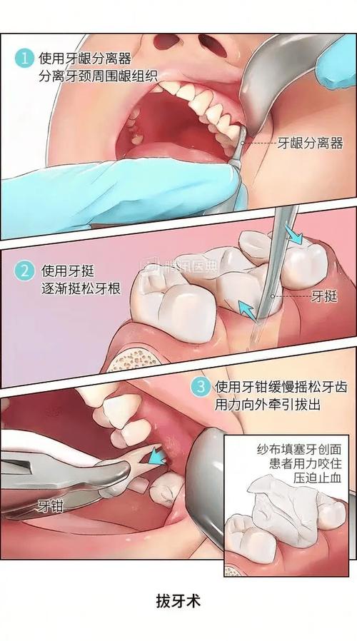 无痛拔牙有几种方法？不同方式优缺点及适用情况解析？-图1