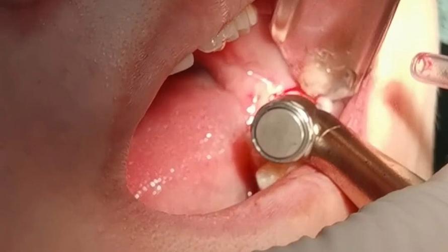 微创拔智齿的正确方法具体该怎么操作？-图1