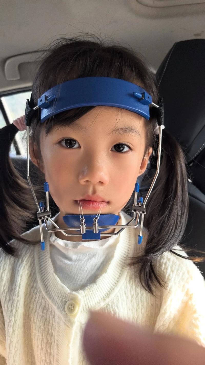 正畸前方牵引器如何正确佩戴？-图1