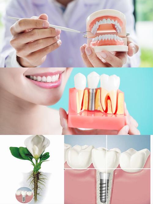 深圳镶牙补牙种牙服务该怎么选?哪种方式更适合自己呢?-图2 深圳镶牙补牙种牙服务该怎么选?哪种方式更适合自己呢?-图2