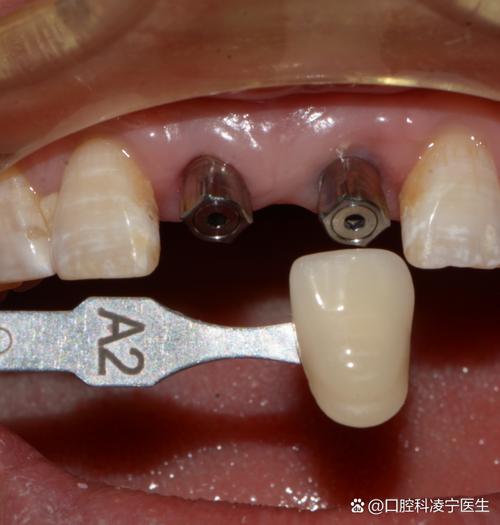 深圳镶牙补牙种牙服务该怎么选?哪种方式更适合自己呢?-图3 深圳镶牙补牙种牙服务该怎么选?哪种方式更适合自己呢?-图3