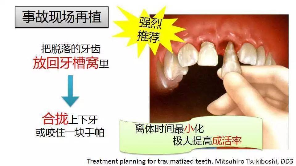 牙齿脱落后如何再植？具体方法有哪些？-图3