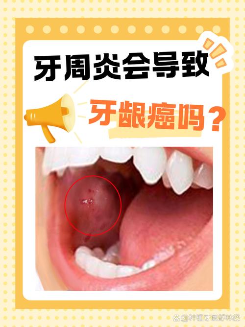 牙周炎患者种牙真的有必要吗?-图2 牙周炎患者种牙真的有必要吗?-图2