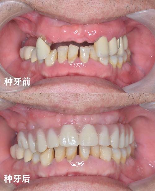 种牙后旁边牙齿会动?原因何在?是否正常?-图1 种牙后旁边牙齿会动?原因何在?是否正常?-图1