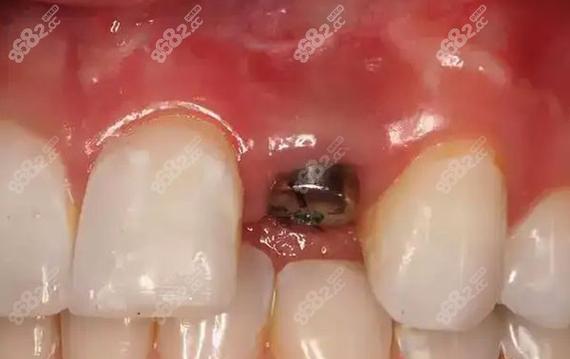 种牙后旁边牙齿会动?原因何在?是否正常?-图2 种牙后旁边牙齿会动?原因何在?是否正常?-图2