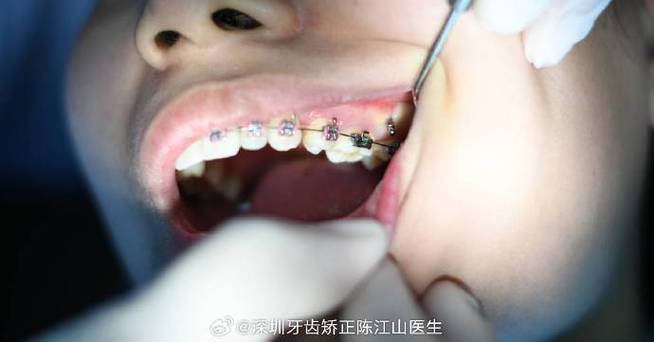 正畸种植钉松动,口外弓使用是诱因吗?-图1 正畸种植钉松动,口外弓使用是诱因吗?-图1