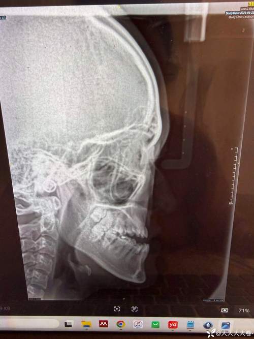 正畸头影测量分析报告的关键指标如何解读以指导正畸方案制定？-图3