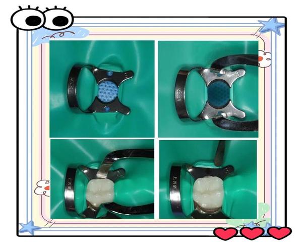 橡皮障拍片的方法有哪些关键操作步骤？-图1