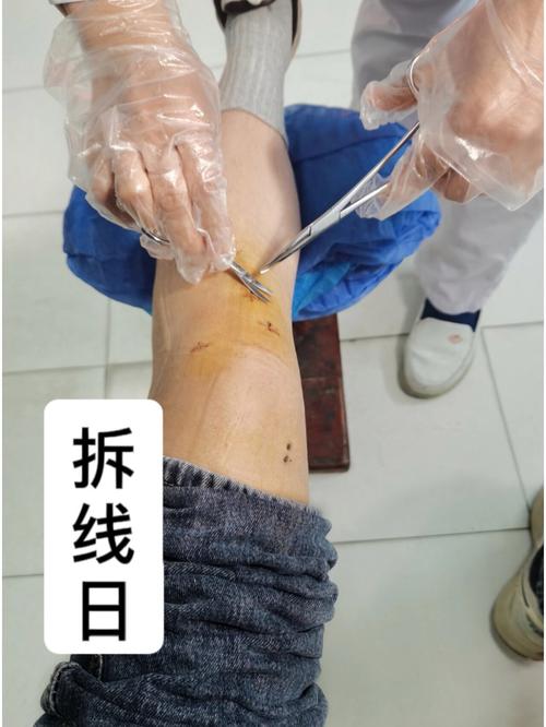 种牙术后拆线前能运动吗？这些注意事项要知晓-图2