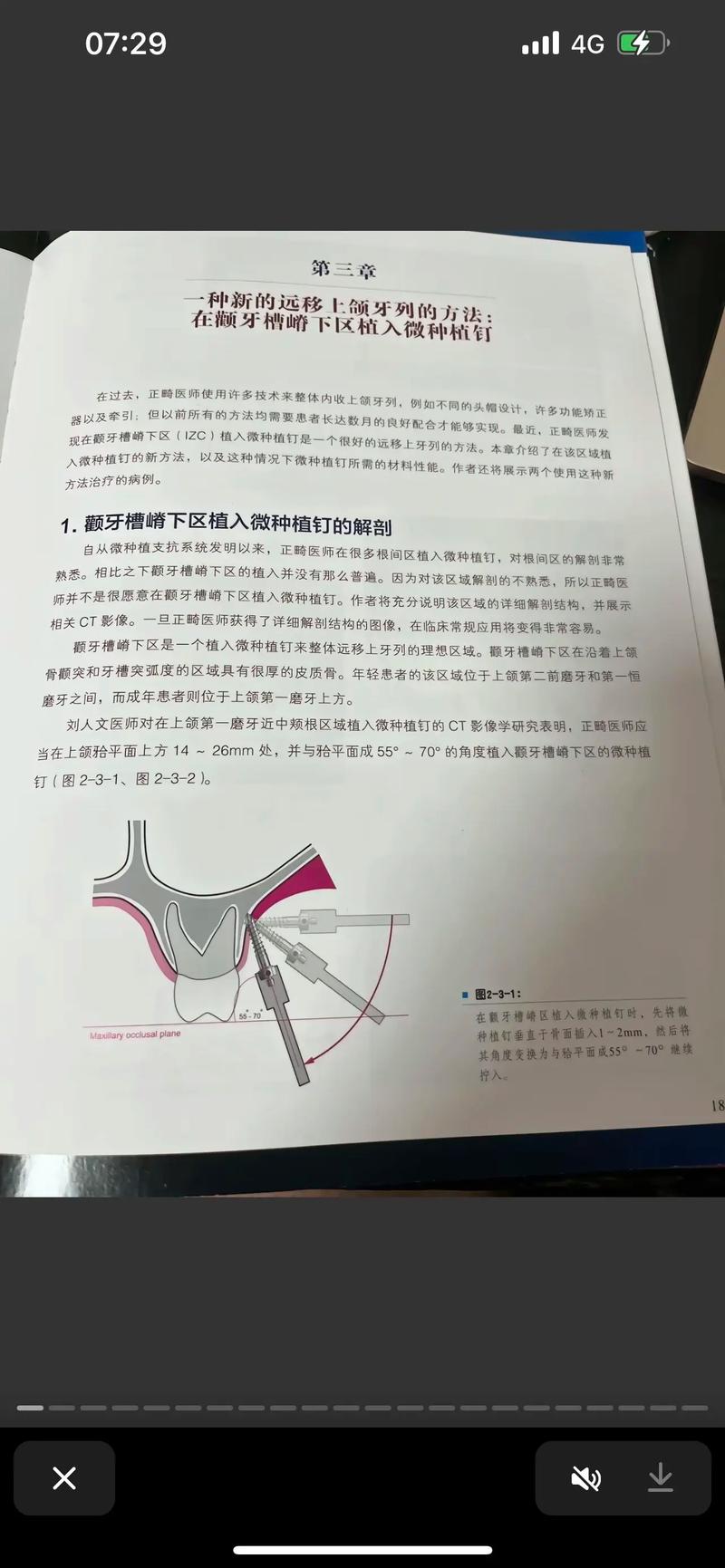正畸支抗钉植入方法的关键步骤与操作要点是什么？-图1