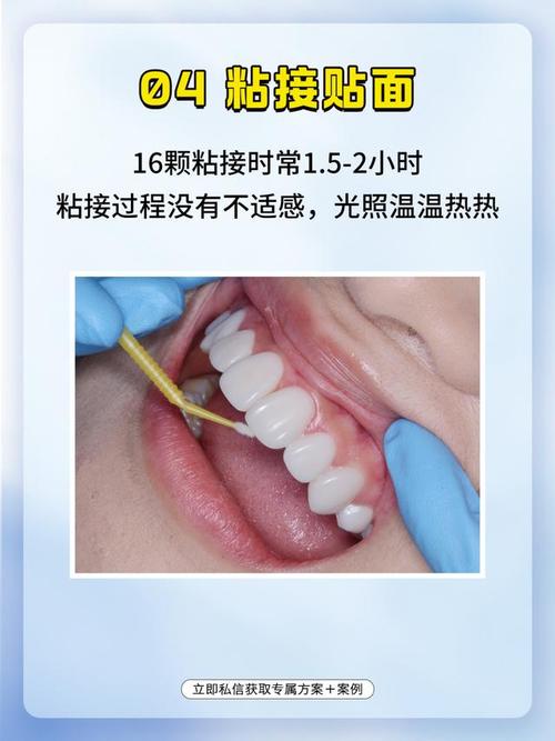 贴面修复的预备方法具体包含哪些关键步骤和注意事项？-图1
