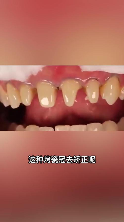 做完美容冠后还能进行牙齿正畸吗？-图2