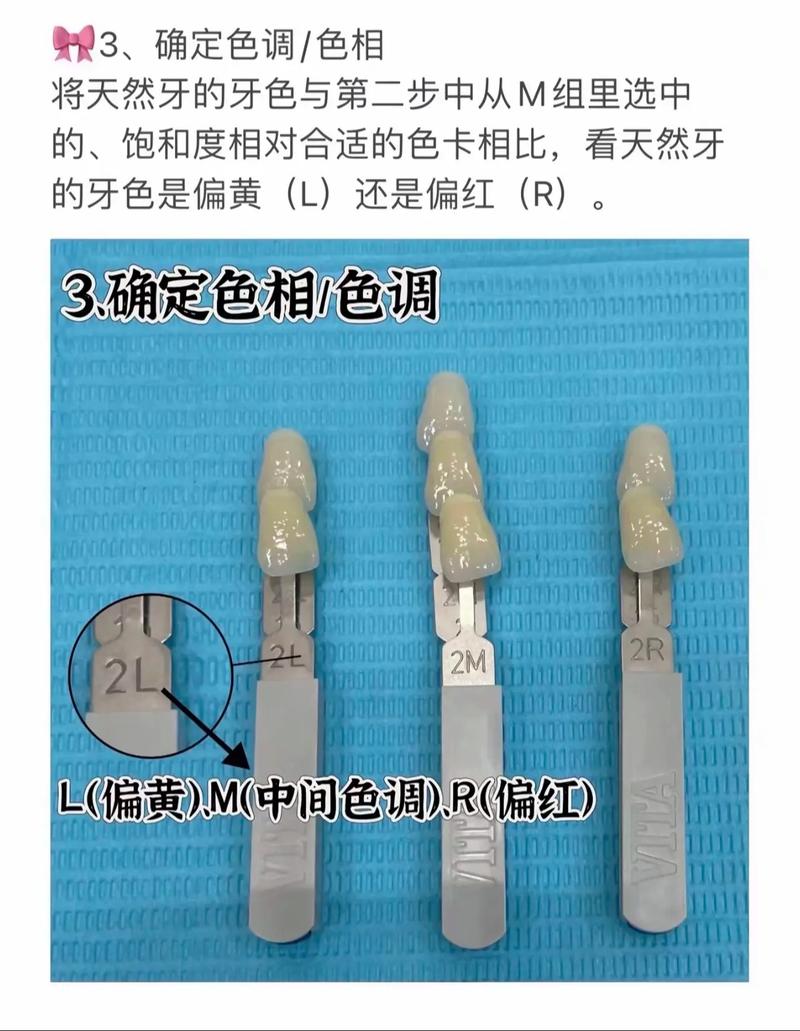 口腔比色仪的分类方法具体包含哪些分类标准和类型?-图1 口腔比色仪的分类方法具体包含哪些分类标准和类型?-图1