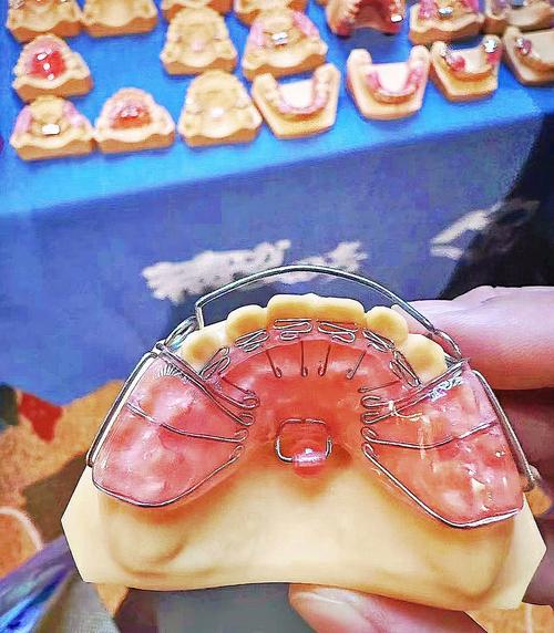 正畸单牙前牙正转矩簧对单颗前牙正转矩的控制原理与临床效果如何?-图2 正畸单牙前牙正转矩簧对单颗前牙正转矩的控制原理与临床效果如何?-图2