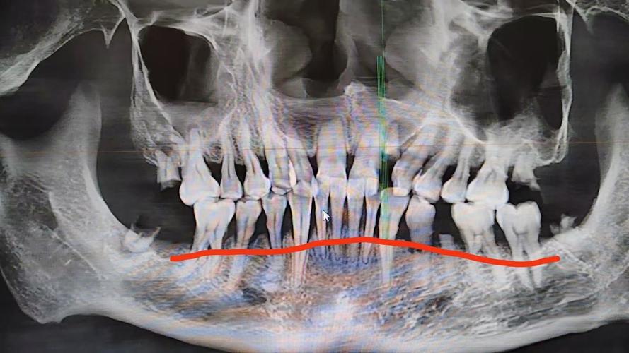 正畸后牙槽吸收X光能发现什么问题？-图1