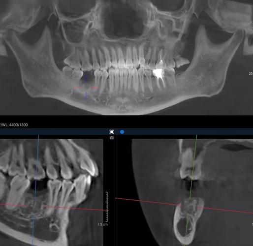 根管治疗后牙齿正畸可行？效果及注意事项如何-图2