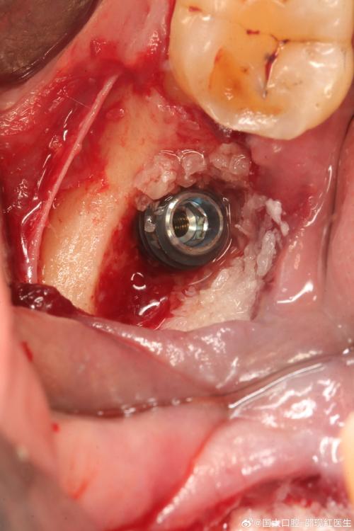 植骨后牙颌骨能种牙吗?需要多久能种?成功率如何?-图2 植骨后牙颌骨能种牙吗?需要多久能种?成功率如何?-图2