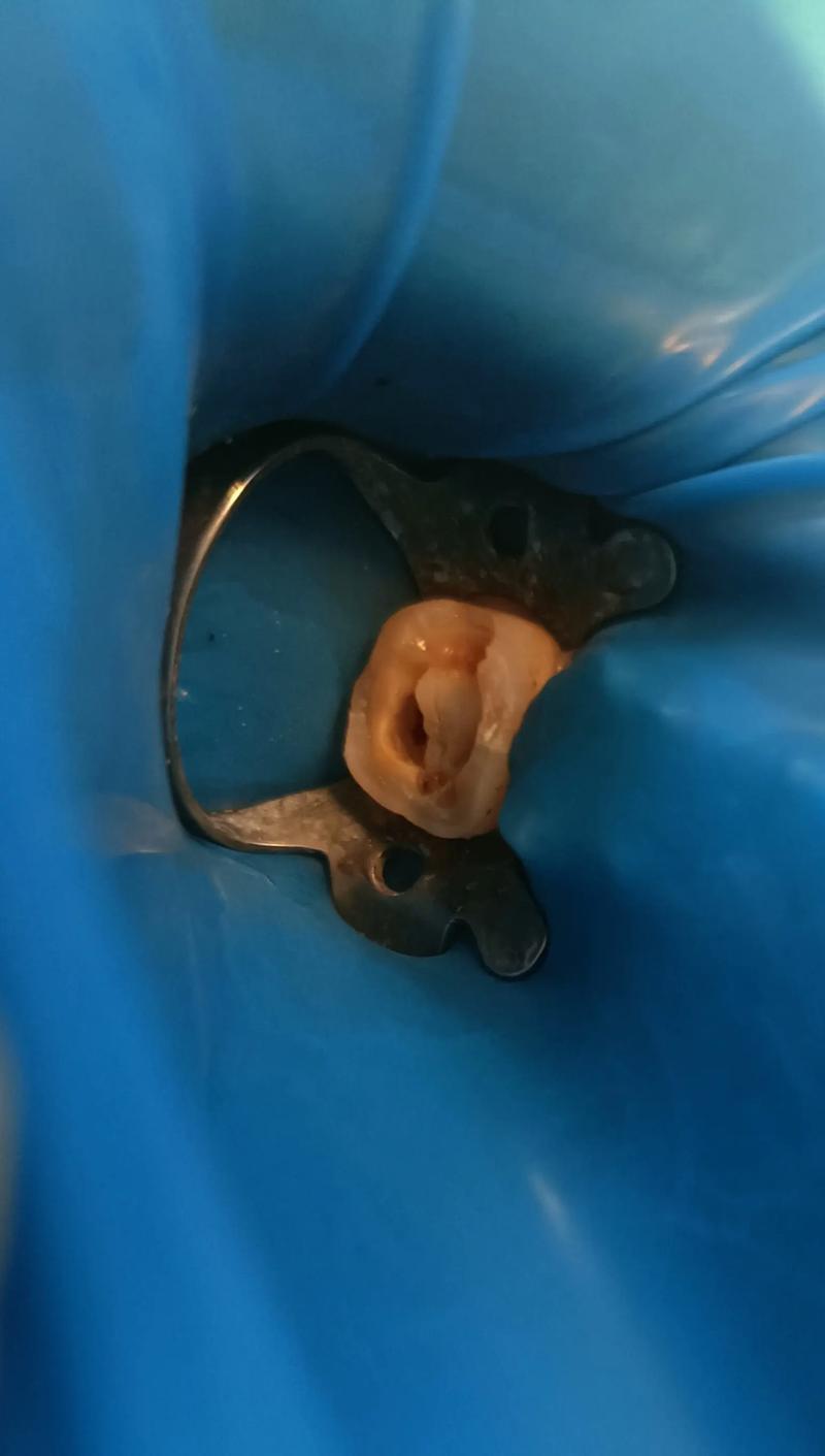 一颗牙没有可种牙吗-图3