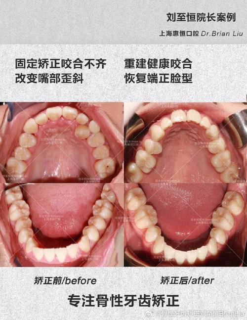 倾斜牙矫正牙齿的方法有哪些?不同方法效果有何差异?-图2 倾斜牙矫正牙齿的方法有哪些?不同方法效果有何差异?-图2