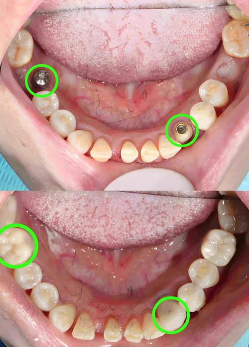 种牙哪里种得好？关键看这几点，你选对医院医生了吗？-图2