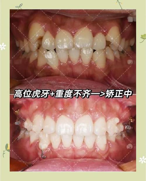 杭州虎牙矫正有哪些方法?如何选择适合自己的矫正方式?-图3 杭州虎牙矫正有哪些方法?如何选择适合自己的矫正方式?-图3