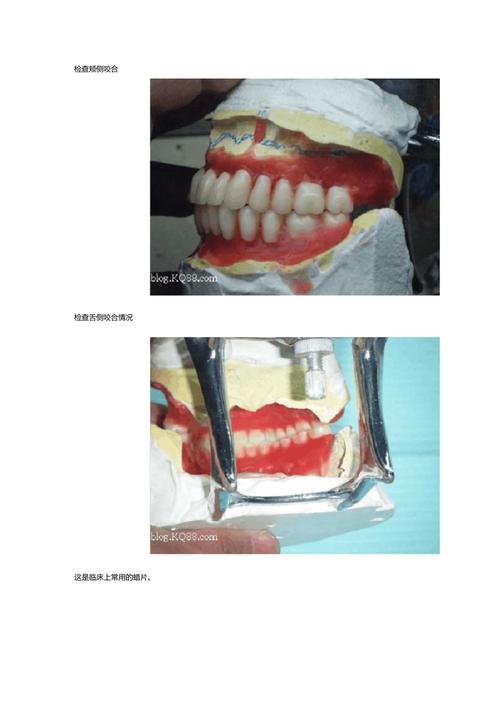 义齿变形的处理方法-图1 义齿变形的处理方法-图1
