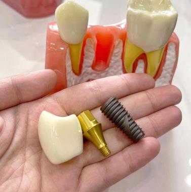 登腾种牙12000是否划算？包含哪些项目？-图2