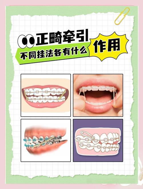 正畸橡皮链怎么安装？详细方法与操作技巧全解析-图1