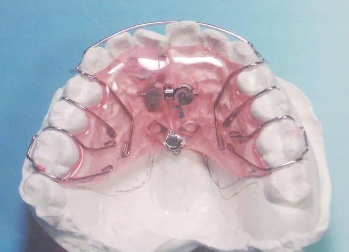 肌功能矫治器正畸图片能直观展示哪些不同矫正作用、效果及适用人群？-图2