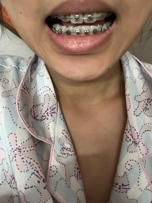 正畸后戴保持器难受,是正常现象吗?原因是什么?怎么缓解?-图3 正畸后戴保持器难受,是正常现象吗?原因是什么?怎么缓解?-图3