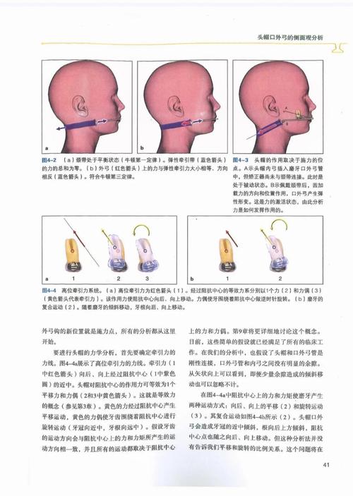 口腔正畸力学书籍,如何将力学原理转化为临床矫治力呢?-图3 口腔正畸力学书籍,如何将力学原理转化为临床矫治力呢?-图3