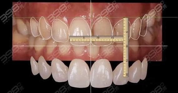 开窗式贴面预备方法的关键技术步骤及临床应用价值是什么？-图2