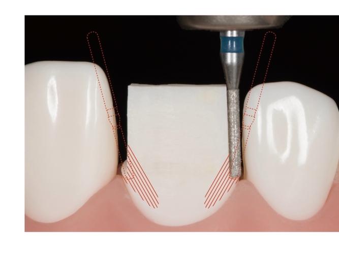 开窗式贴面预备方法的关键技术步骤及临床应用价值是什么？-图1