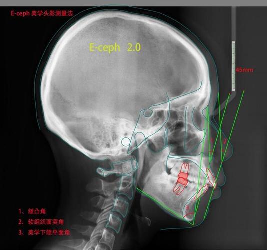正畸头影测量实验报告中的关键数据如何准确辅助正畸临床决策？-图2